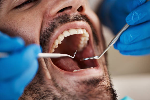 Best Emergency Tooth Extraction in Greentown, OH